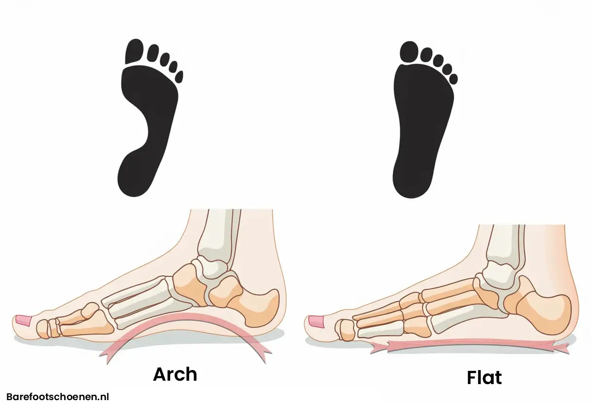 HELP! Ik heb platvoeten! (Pes Planus)